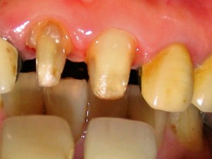 甲1　ラミネートべニア　と　オールセラミッククラウン　削り　（前面）◎